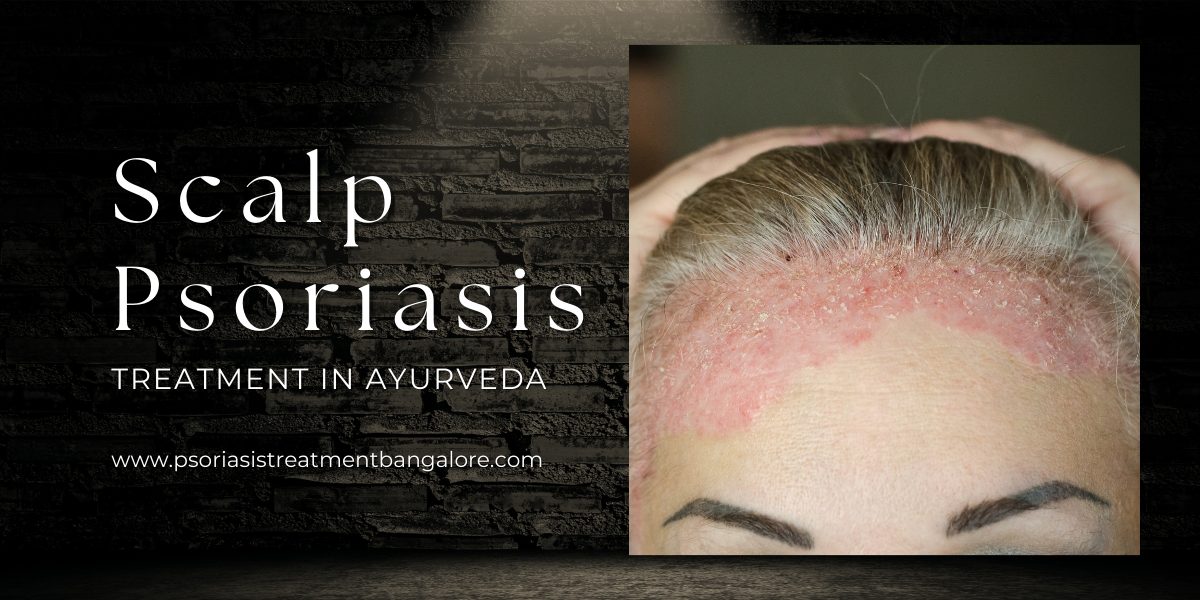 Scalp Psoriasis Treatment in Ayurveda