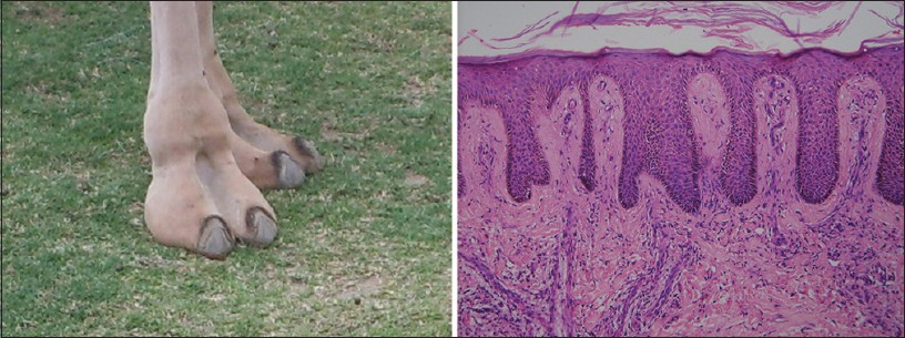 Camel Foot Appearance in Psoriasis