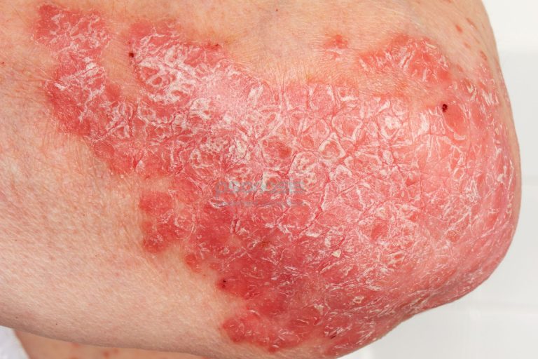 Microinjuries Trigger Psoriasis