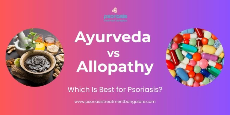 Ayurveda vs Allopathy: Which Is Best for Psoriasis?