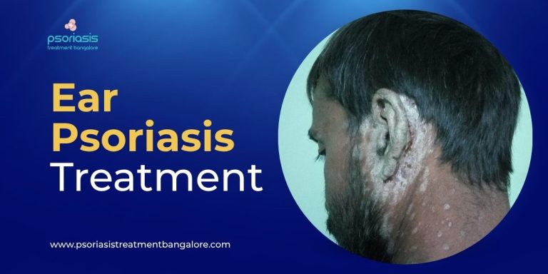 Ear Psoriasis Treatment