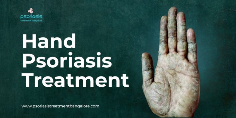 Hand Psoriasis Treatment