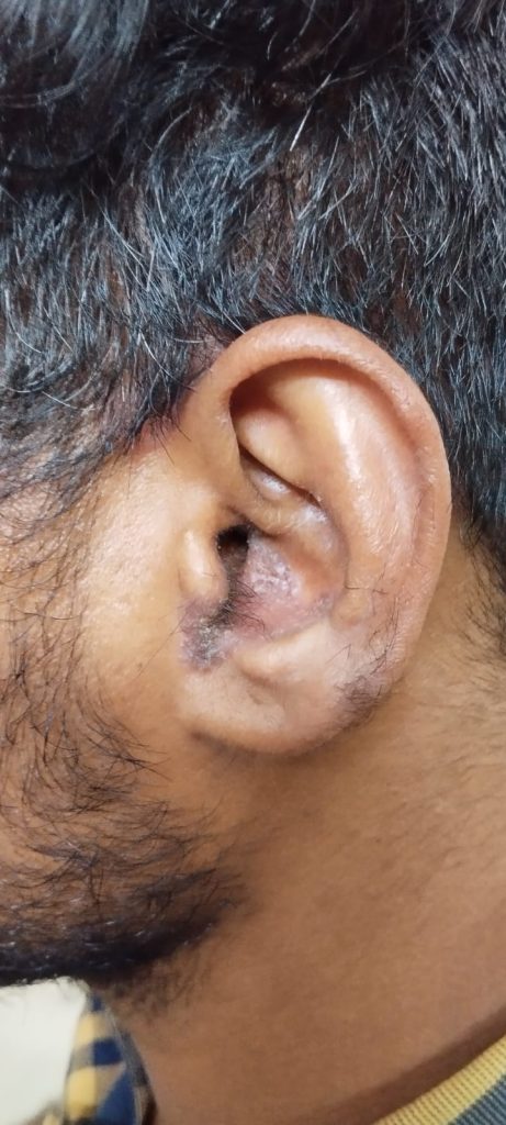 ear psoriasis photos 1