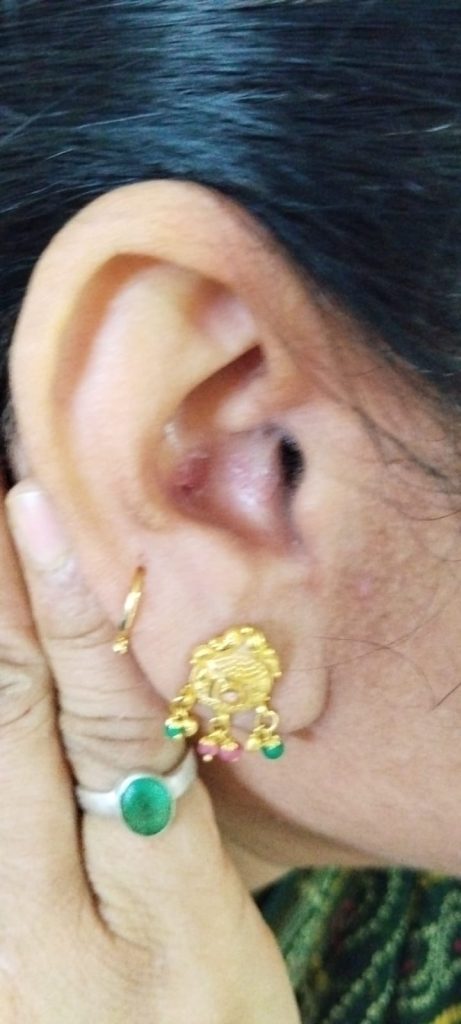 ear psoriasis photos 2