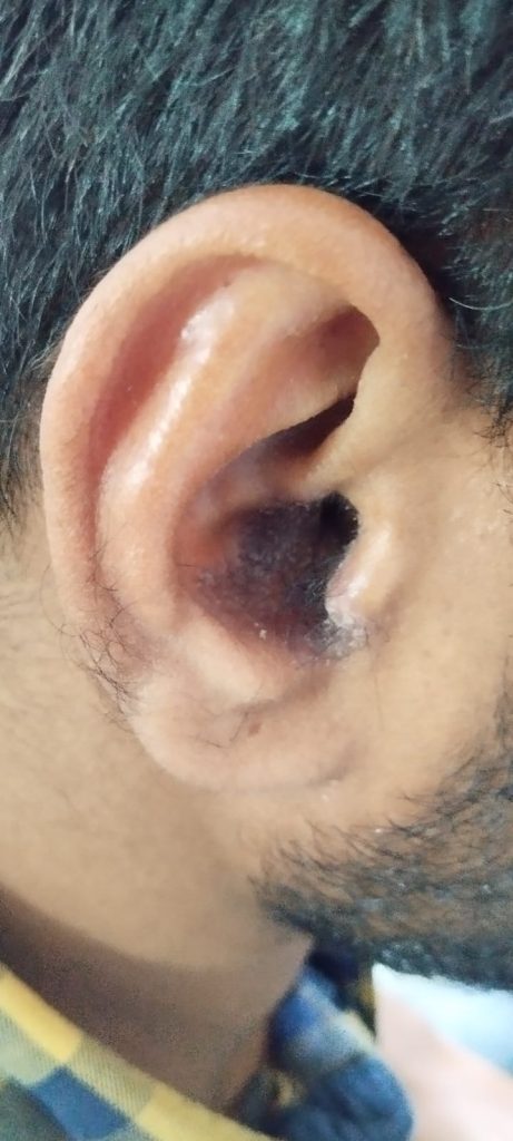 ear psoriasis photos 3