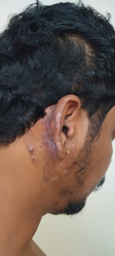 ear psoriasis photos 4
