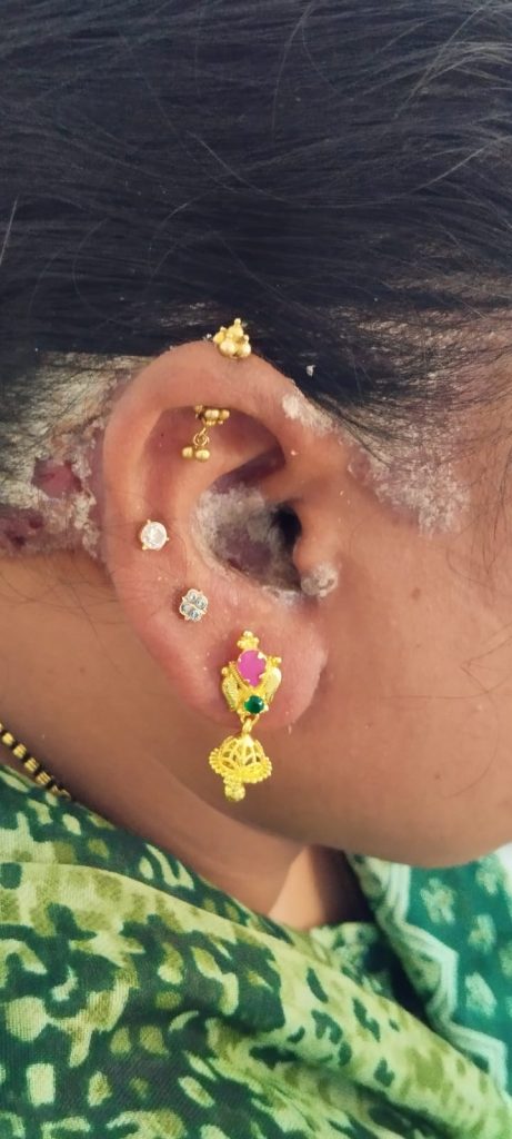 ear psoriasis images 1
