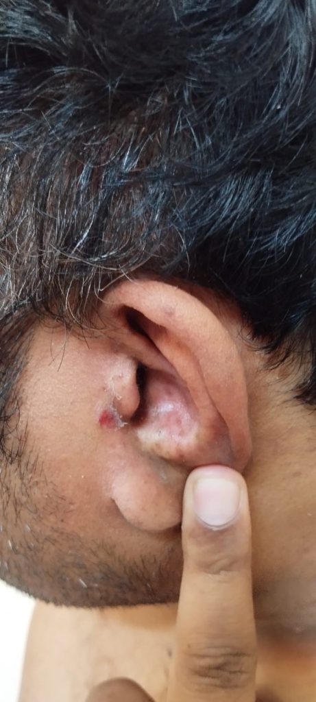 ear psoriasis images 1
