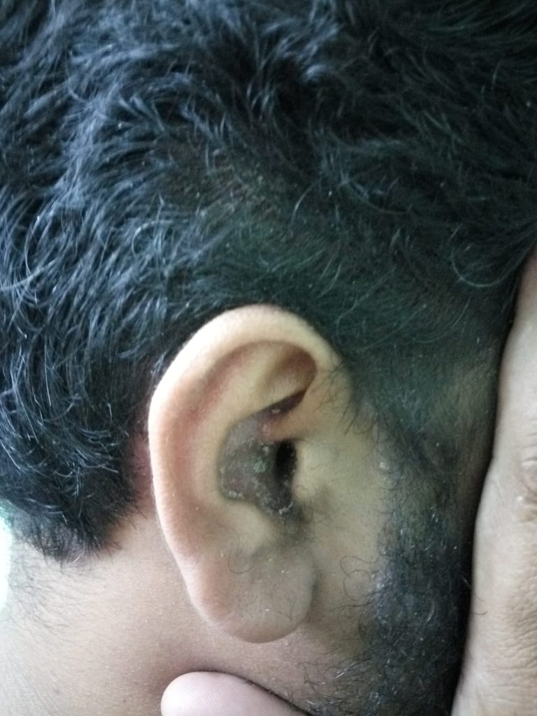 ear psoriasis images 1