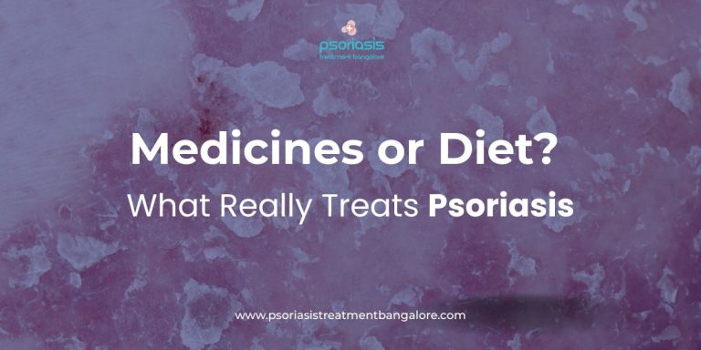 Medicines or Diet What Really Treats Psoriasis