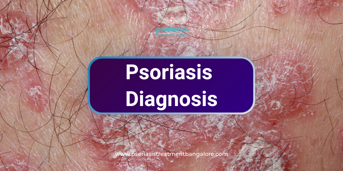 Psoriasis Diagnosis