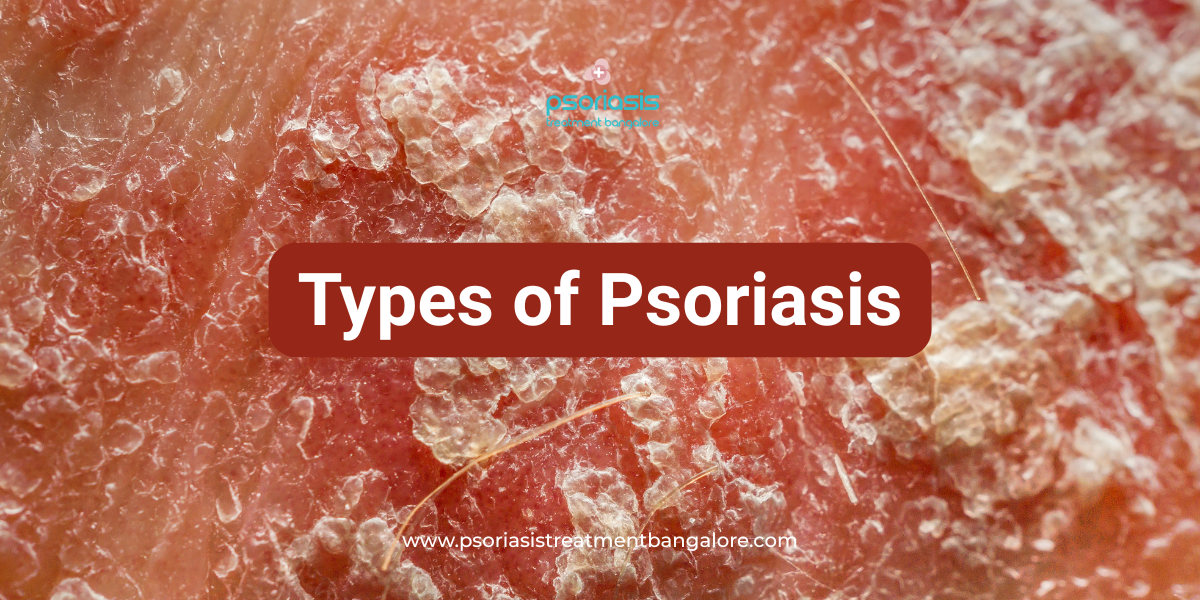 Types of Psoriasis