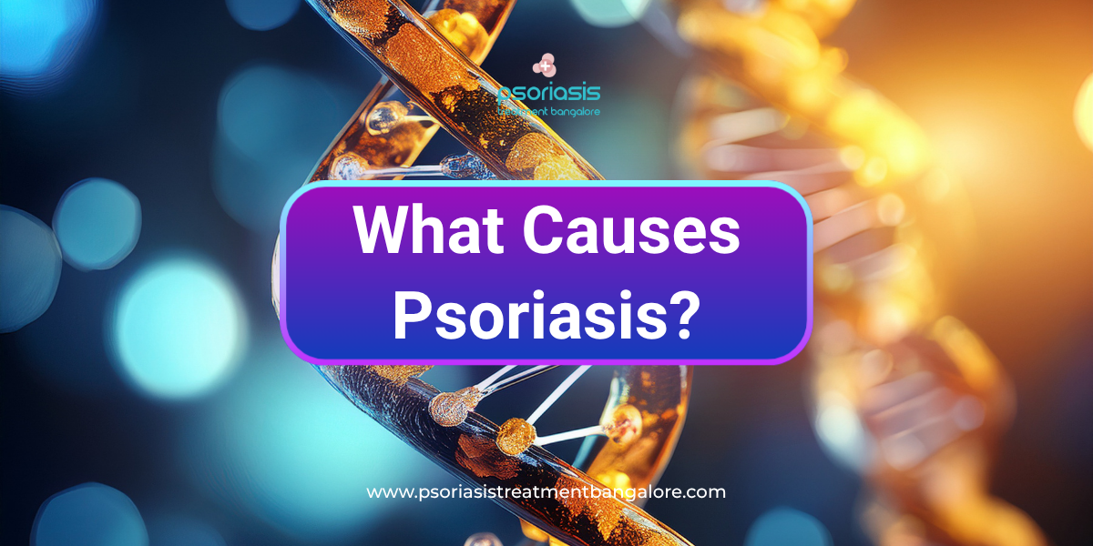 What Causes Psoriasis