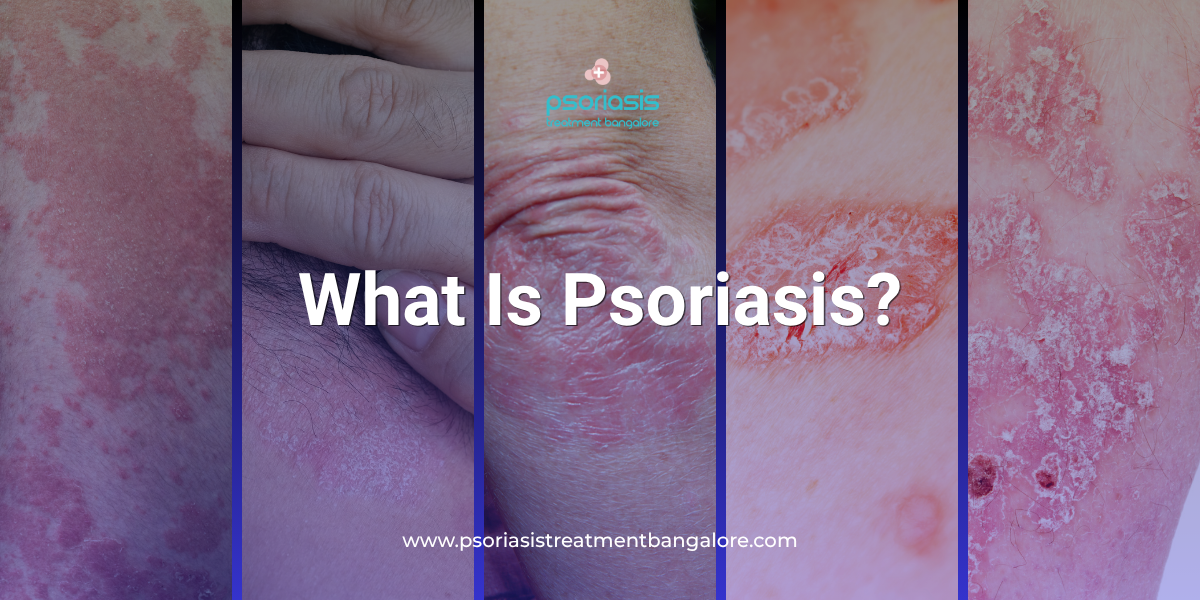 What Is Psoriasis?