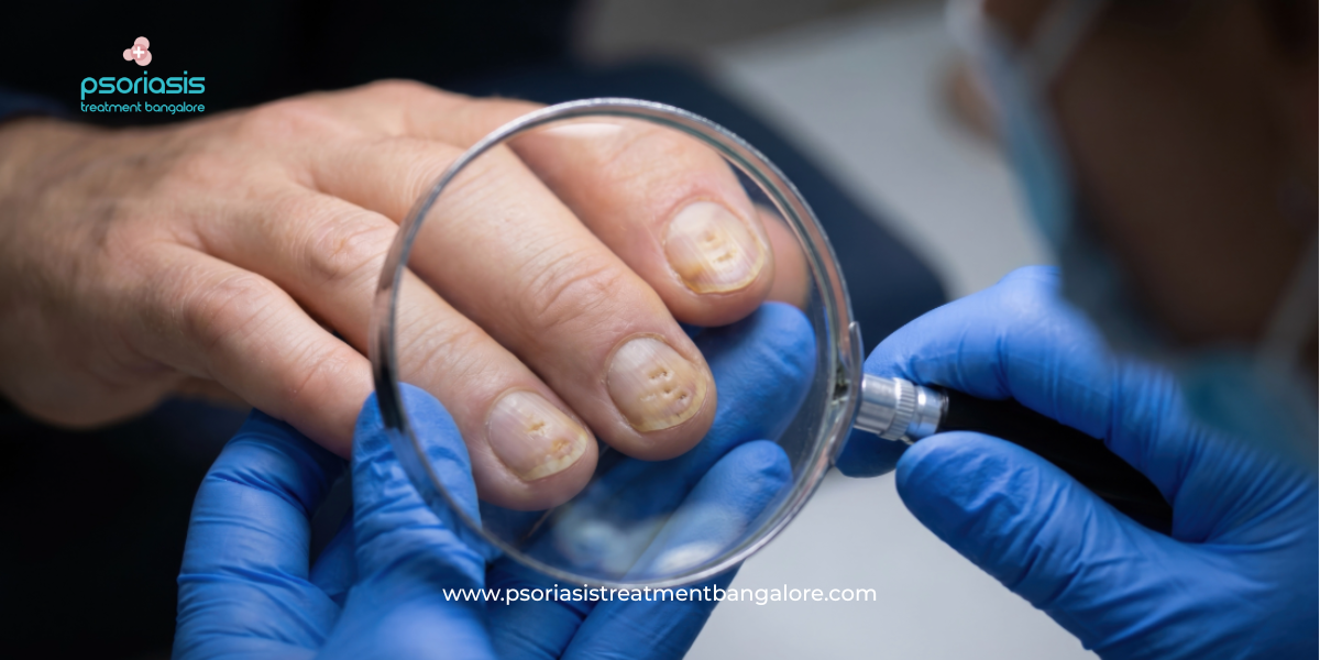 Nail Psoriasis Treatment in Bangalore