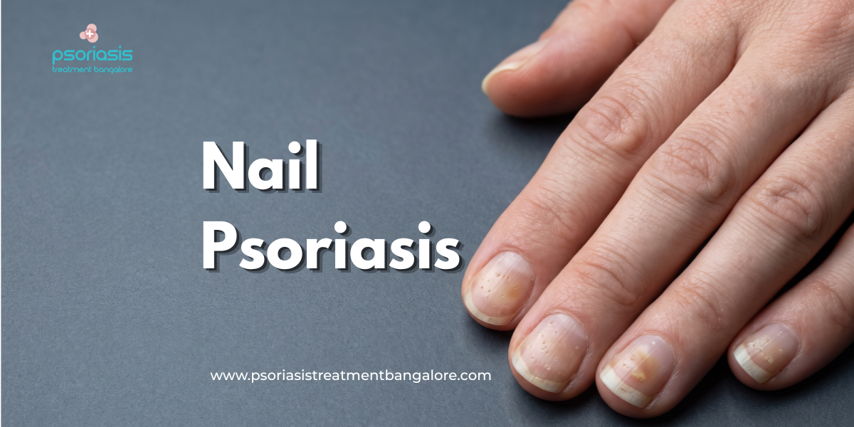 Nail Psoriasis