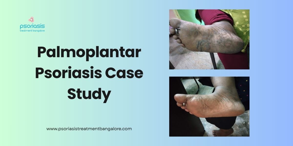 Palmoplantar Psoriasis Case Study