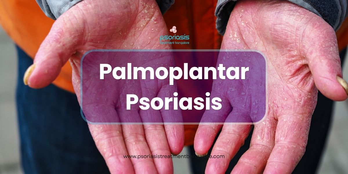 Palmoplantar Psoriasis