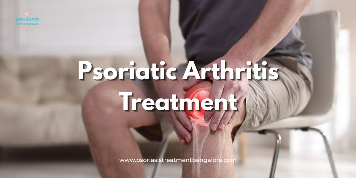 Psoriatic Arthritis Treatment in Bangalore