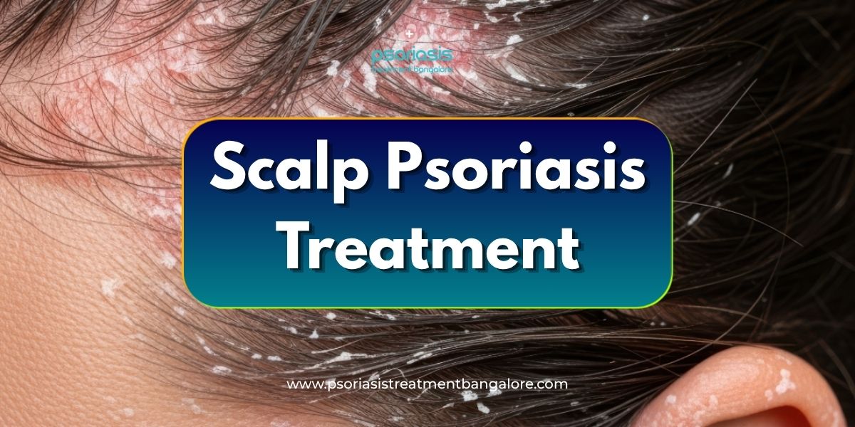 Scalp Psoriasis Treatment in Bangalore