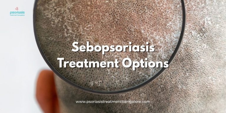 Sebopsoriasis Treatment Options