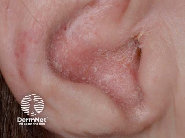 Sebopsoriasis-1