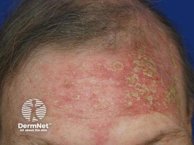 Sebopsoriasis-2