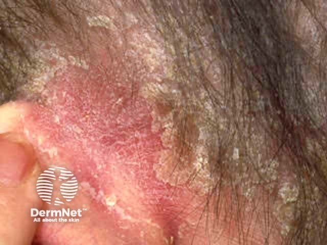 Sebopsoriasis-4
