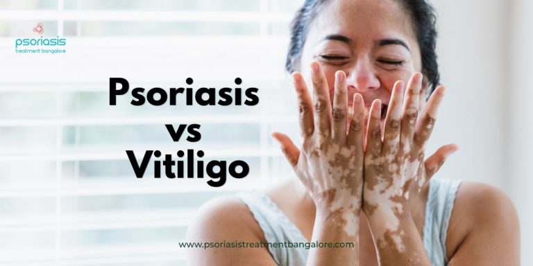 Psoriasis vs Vitiligo
