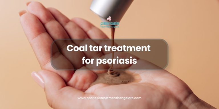 Coal tar treatment for psoriasis