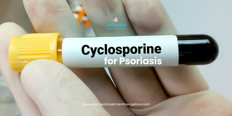 Cyclosporine for Psoriasis