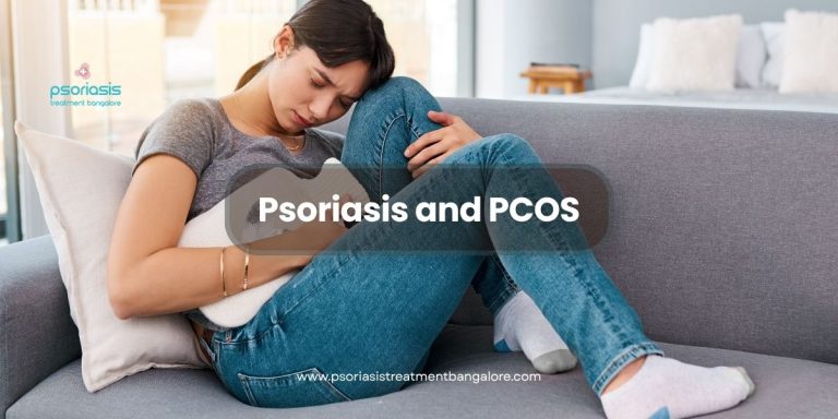 Psoriasis and PCOS