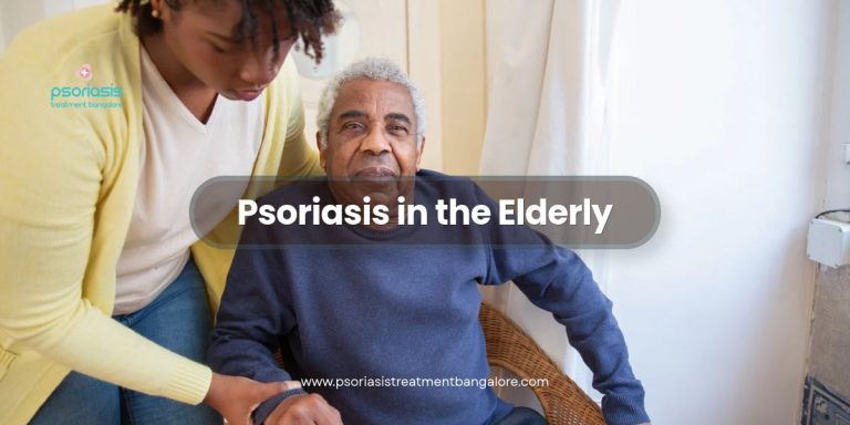 Psoriasis in the Elderly