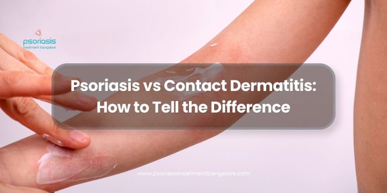 Psoriasis vs Contact Dermatitis: How to Tell the Difference