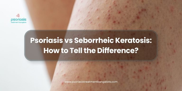 Psoriasis vs Seborrheic Keratosis: How to Tell the Difference