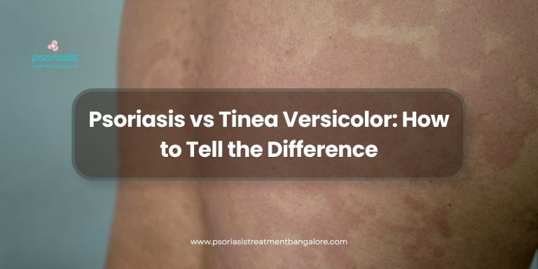 Psoriasis vs Tinea Versicolor: How to Tell the Difference